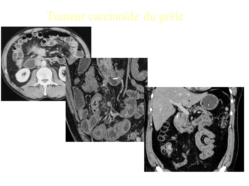 Tumeur carcinoïde du grêle