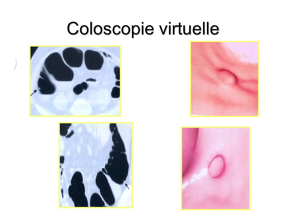 Coloscopie virtuelle )
