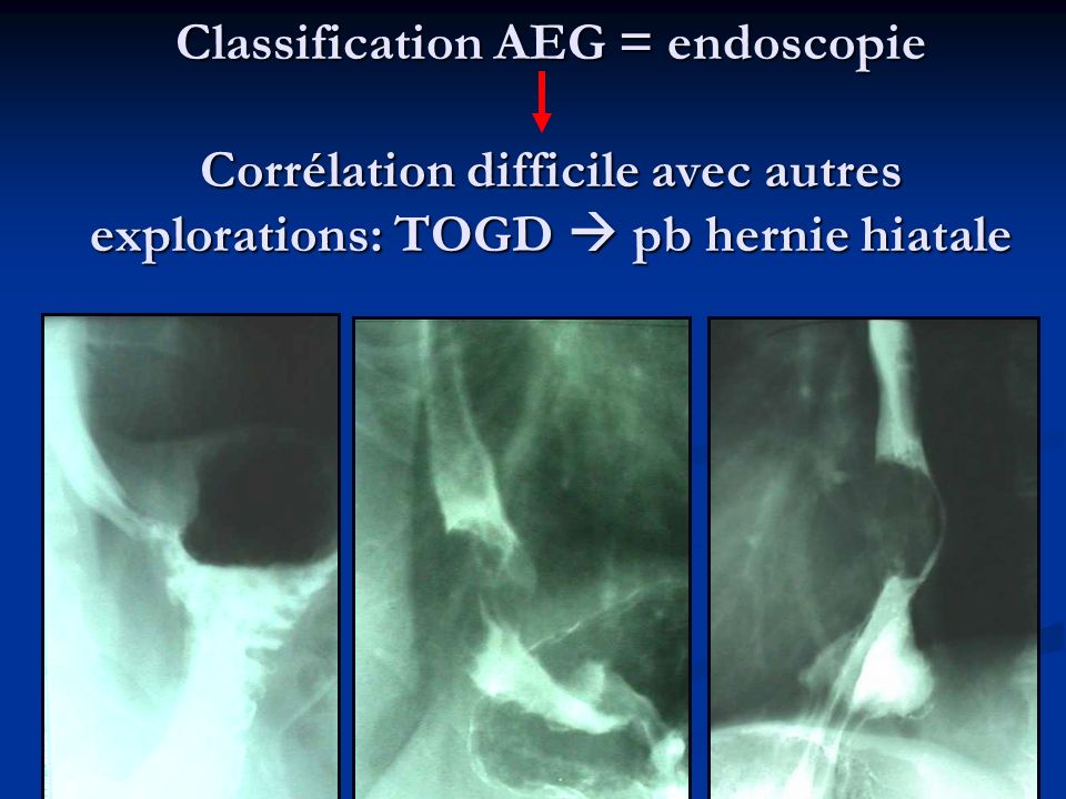 Classification AEG = endoscopie Corrélation difficile avec autres explorations: TOGD  pb hernie hiatale