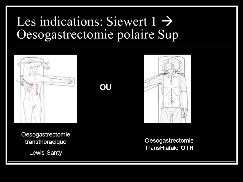 Les indications: Siewert 1  Oesogastrectomie polaire Sup