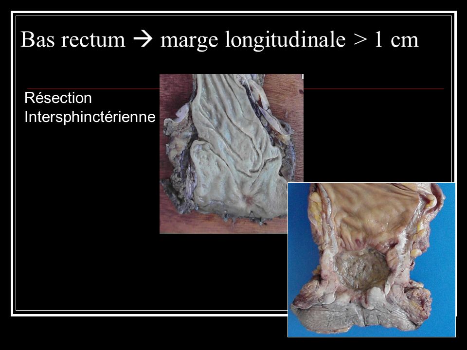 Bas rectum  marge longitudinale > 1 cm