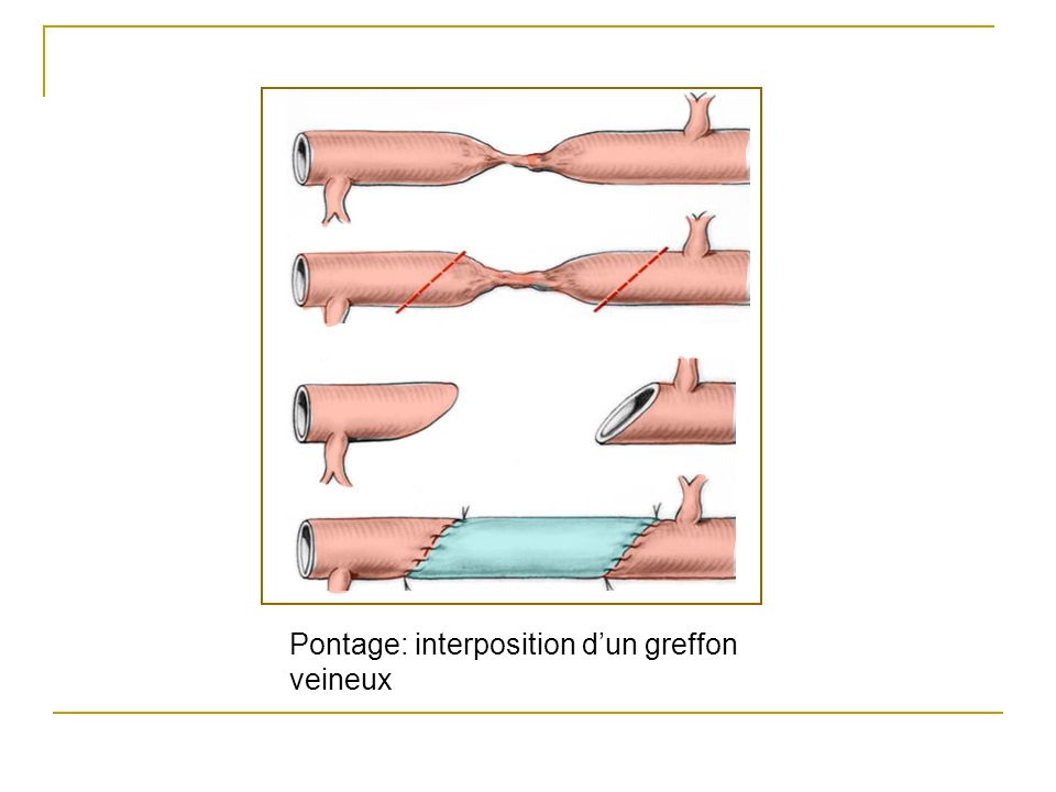 Pontage: interposition d’un greffon veineux