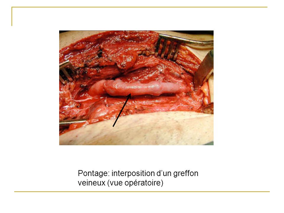 Pontage: interposition d’un greffon veineux (vue opératoire)