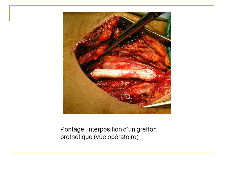 Pontage: interposition d’un greffon prothétique (vue opératoire)