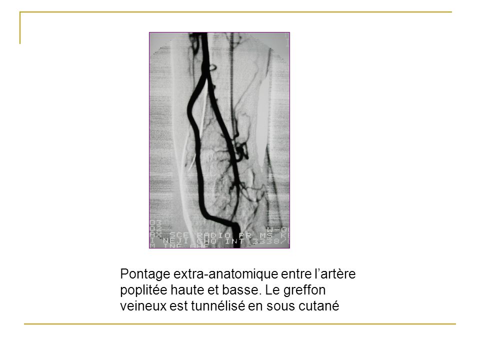 Pontage extra-anatomique entre l’artère poplitée haute et basse