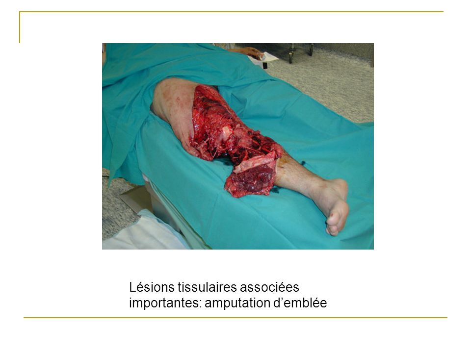Lésions tissulaires associées importantes: amputation d’emblée