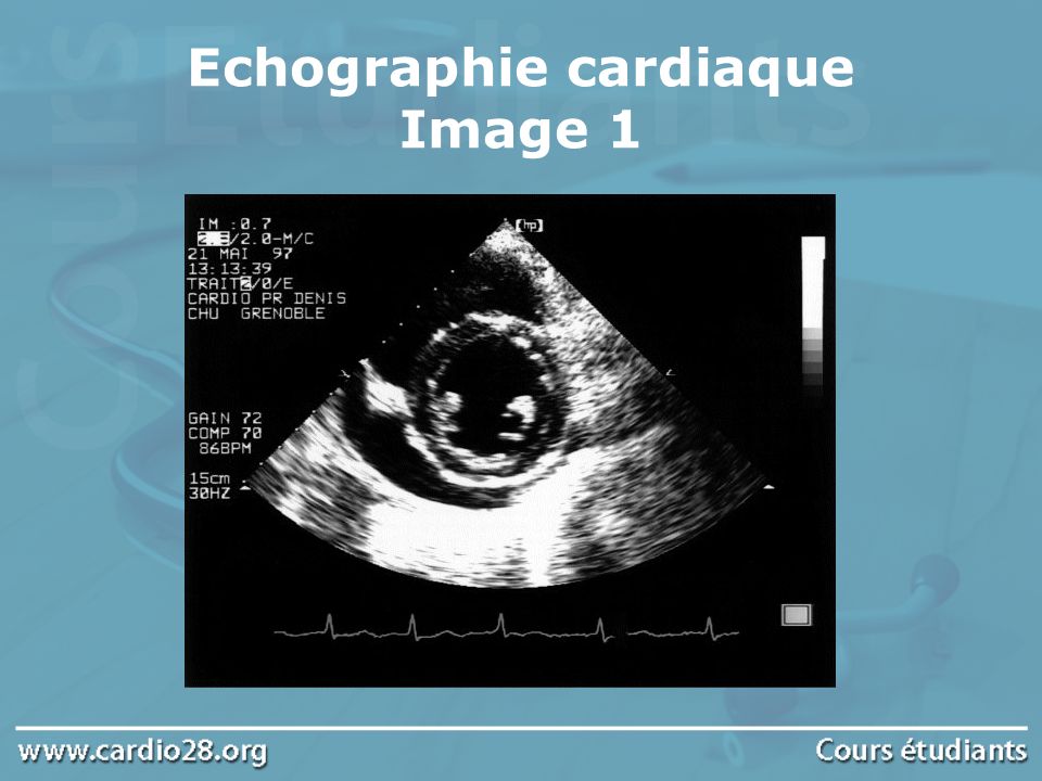 Echographie cardiaque Image 1