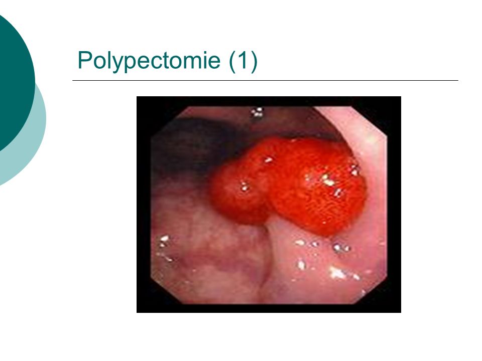 Polypectomie (1)