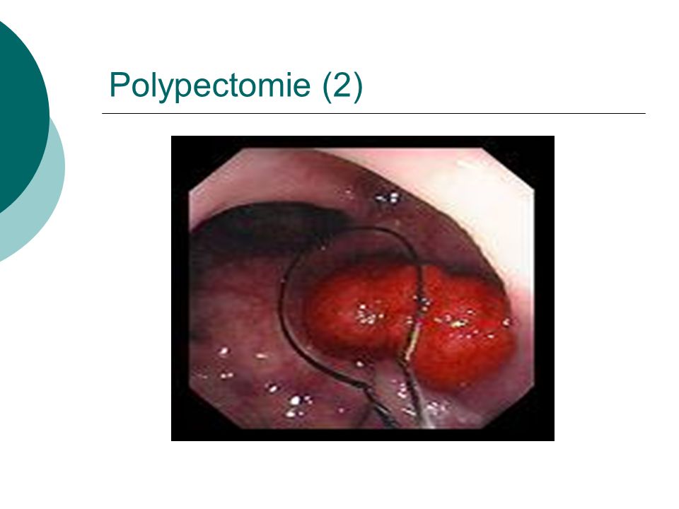 Polypectomie (2)