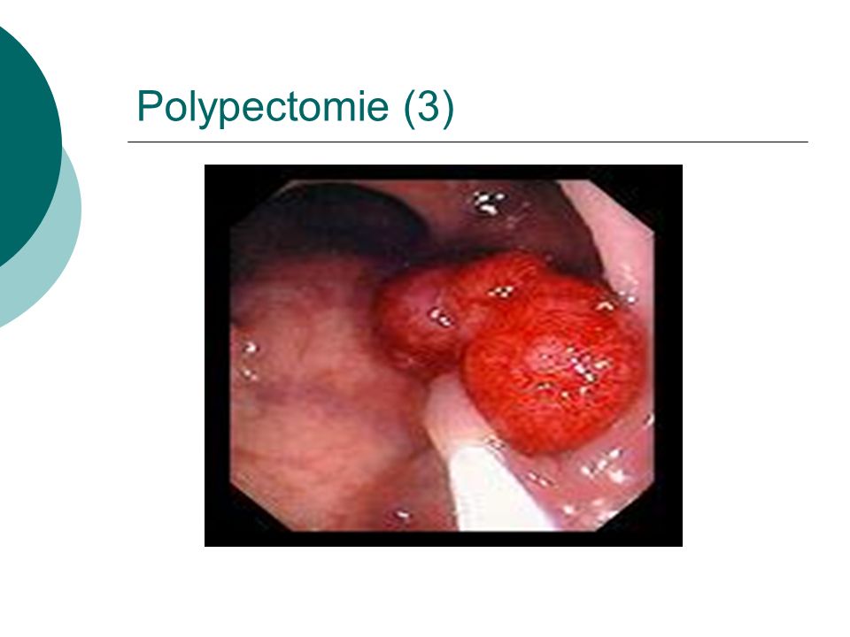 Polypectomie (3)
