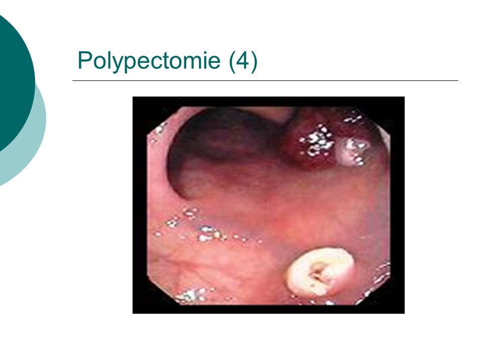 Polypectomie (4)