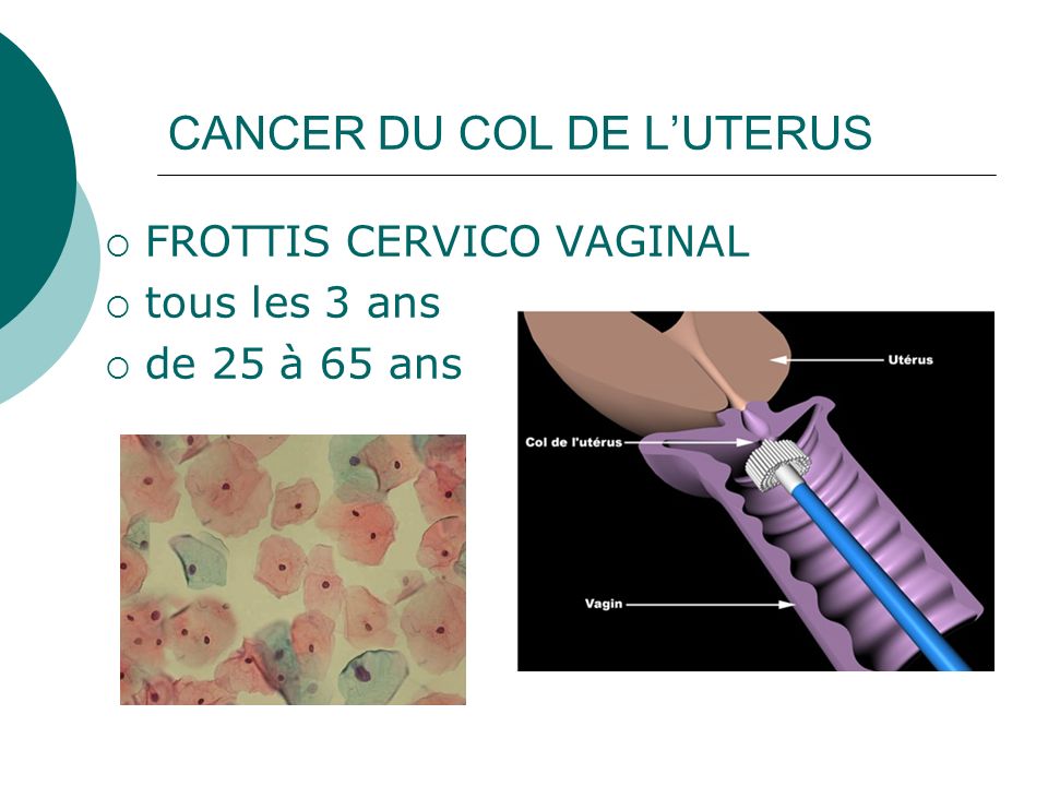 CANCER DU COL DE L’UTERUS
