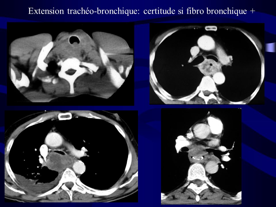 Extension trachéo-bronchique: certitude si fibro bronchique +
