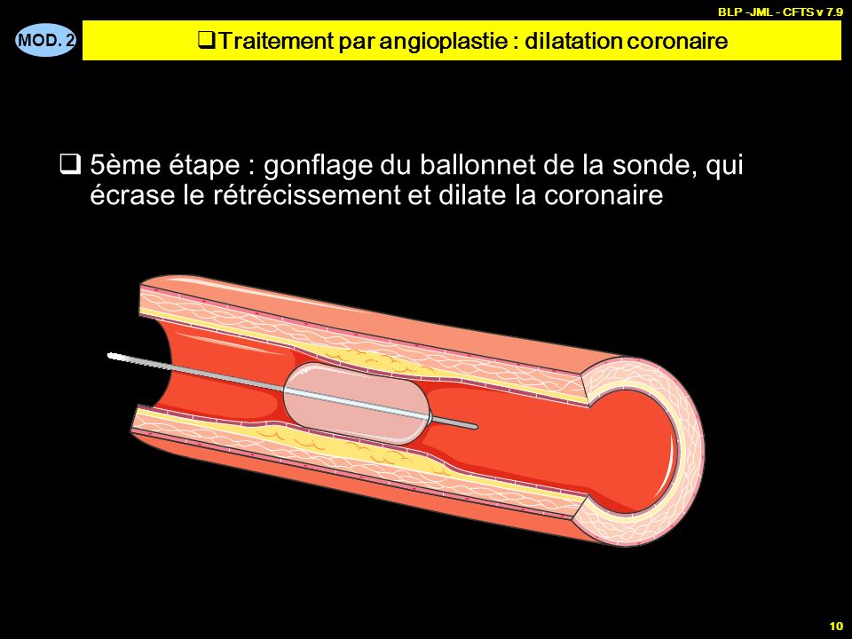 Traitement par angioplastie : dilatation coronaire