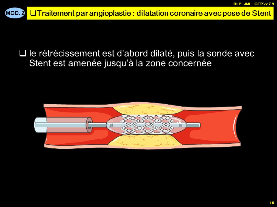 Traitement par angioplastie : dilatation coronaire avec pose de Stent