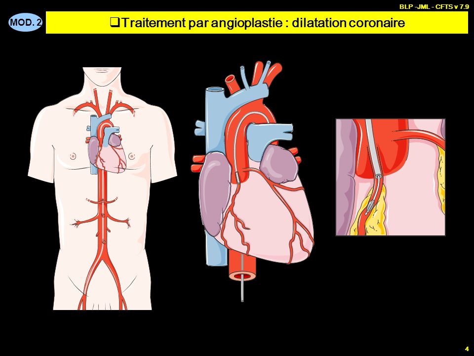 Traitement par angioplastie : dilatation coronaire