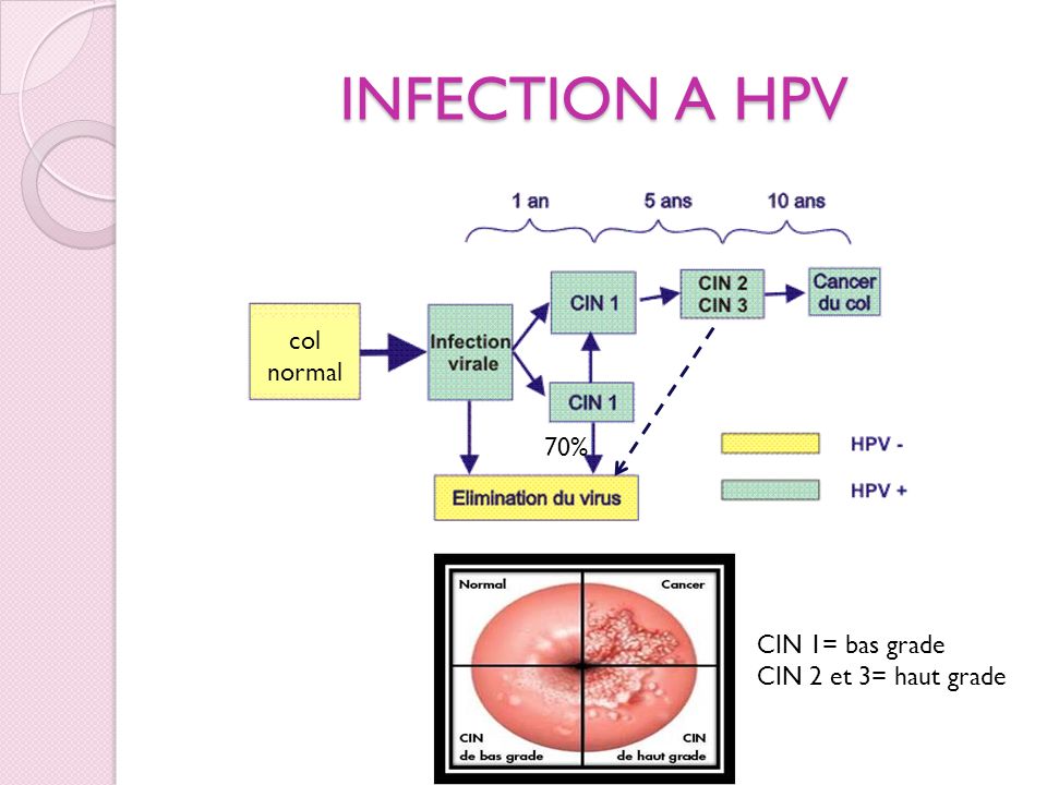 INFECTION A HPV col normal 70% CIN 1= bas grade CIN 2 et 3= haut grade