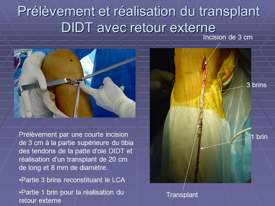 Prélèvement et réalisation du transplant DIDT avec retour externe