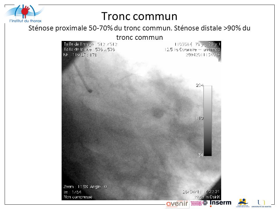 Tronc commun Sténose proximale 50-70% du tronc commun