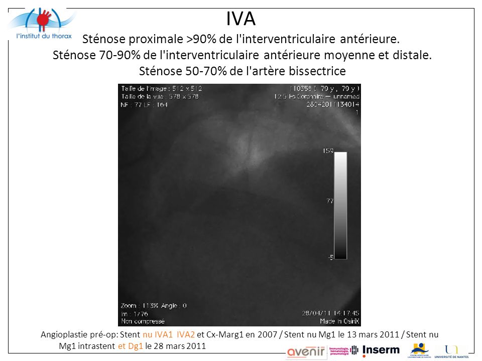 IVA Sténose proximale >90% de l interventriculaire antérieure