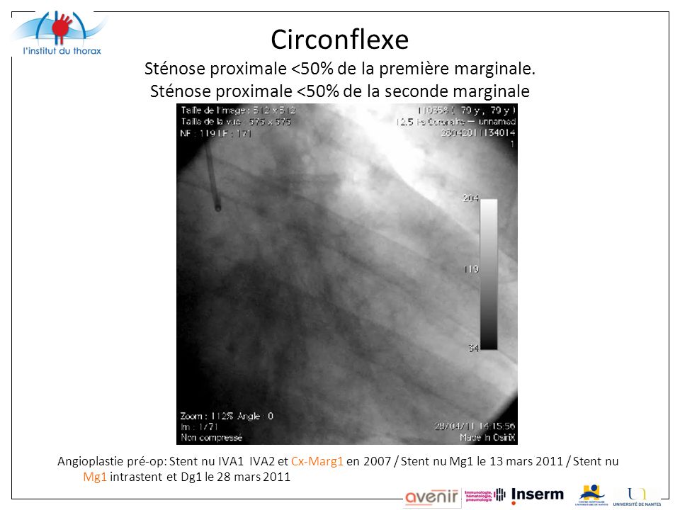Circonflexe Sténose proximale <50% de la première marginale