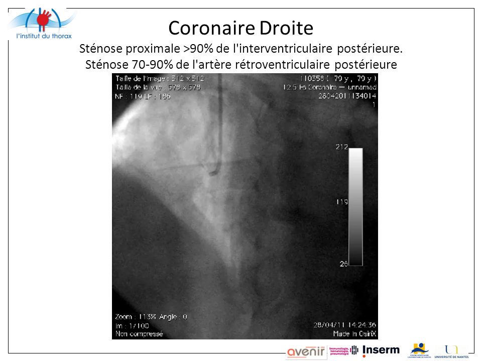 Coronaire Droite Sténose proximale >90% de l interventriculaire postérieure.