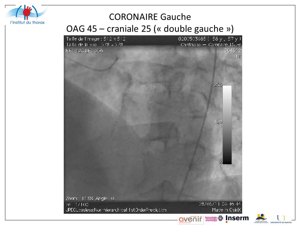 CORONAIRE Gauche OAG 45 – craniale 25 (« double gauche »)
