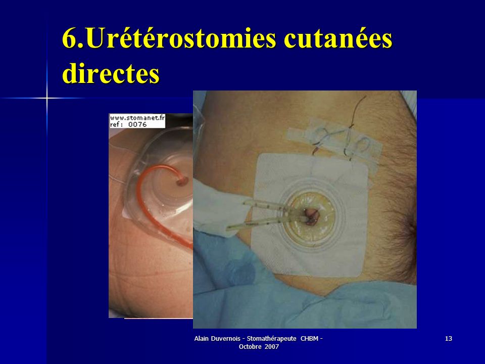 6.Urétérostomies cutanées directes