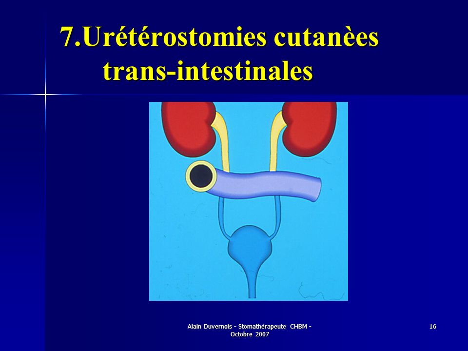 7.Urétérostomies cutanèes trans-intestinales