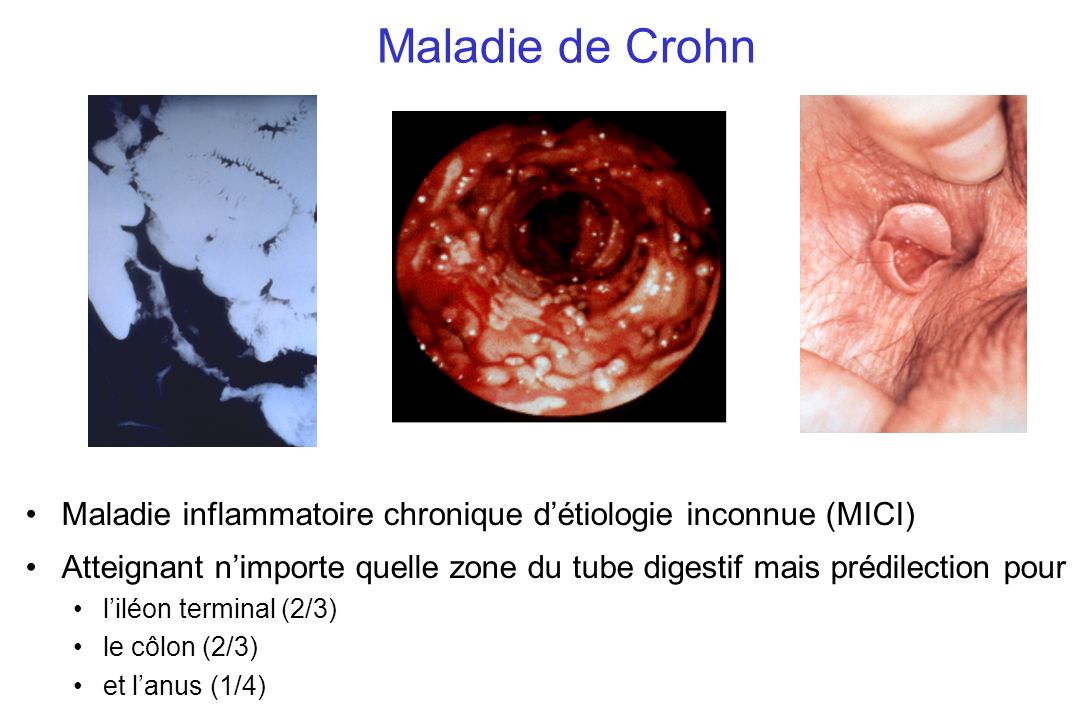 Maladie de Crohn Maladie inflammatoire chronique d’étiologie inconnue (MICI)