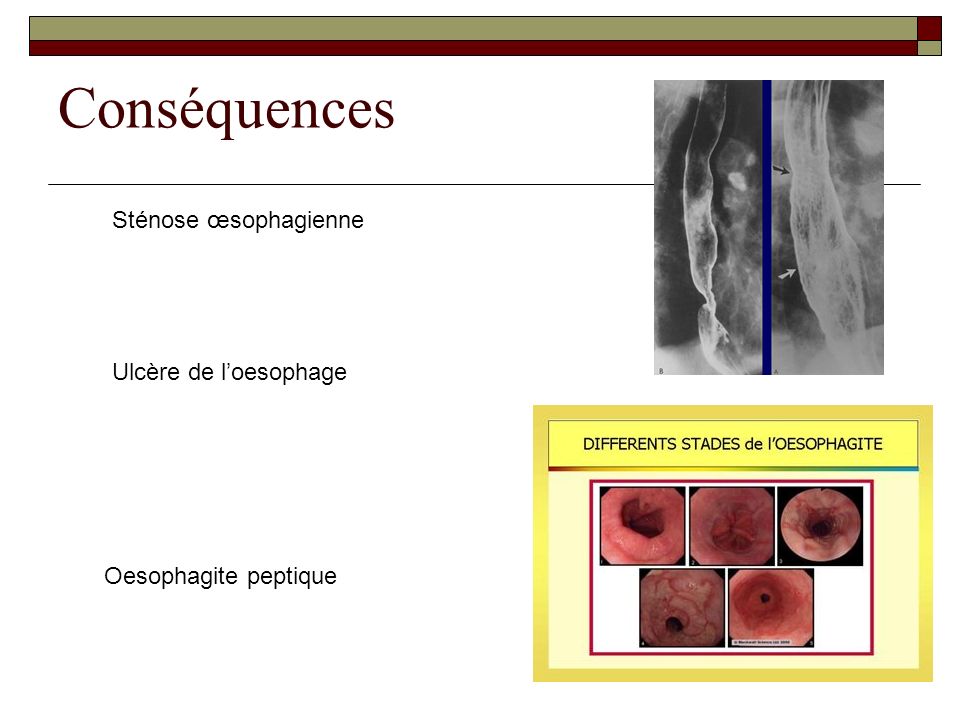 Conséquences Sténose œsophagienne Ulcère de l’oesophage
