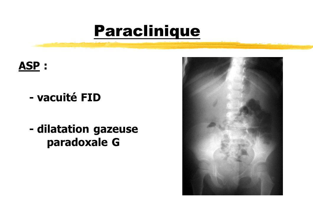 Paraclinique ASP : - vacuité FID - dilatation gazeuse paradoxale G