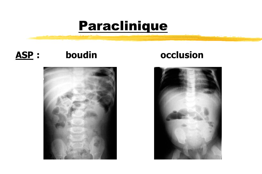 Paraclinique ASP : boudin occlusion