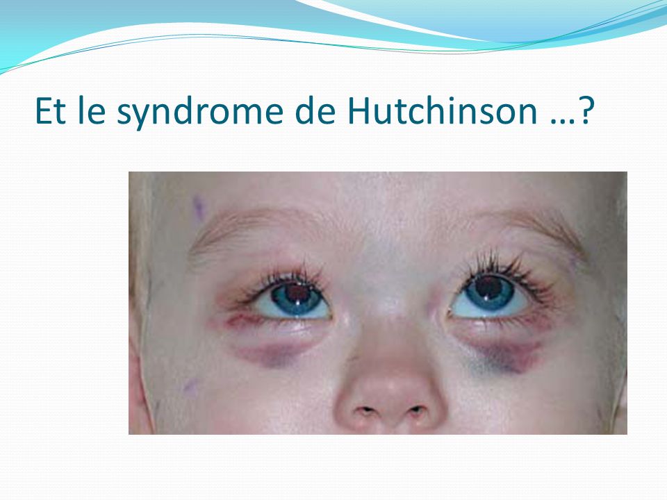 Et le syndrome de Hutchinson …
