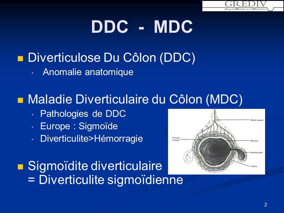 DDC - MDC Diverticulose Du Côlon (DDC)