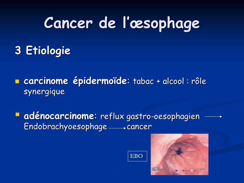Cancer de l’œsophage 3 Etiologie