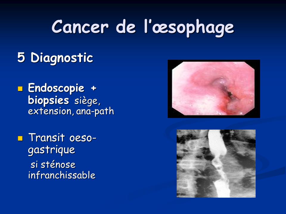 Cancer de l’œsophage 5 Diagnostic