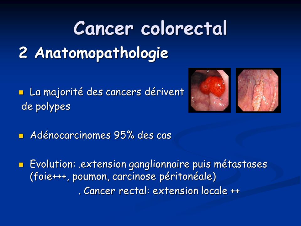 Cancer colorectal 2 Anatomopathologie La majorité des cancers dérivent