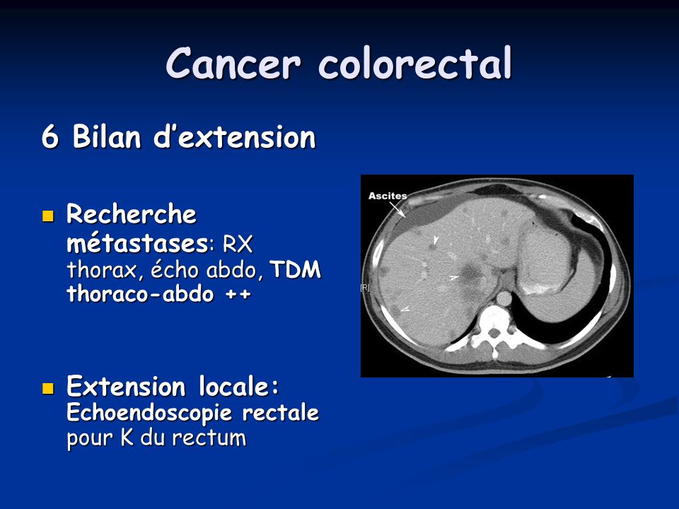 Cancer colorectal 6 Bilan d’extension