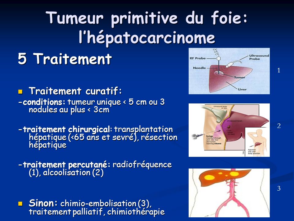 Tumeur primitive du foie: l’hépatocarcinome