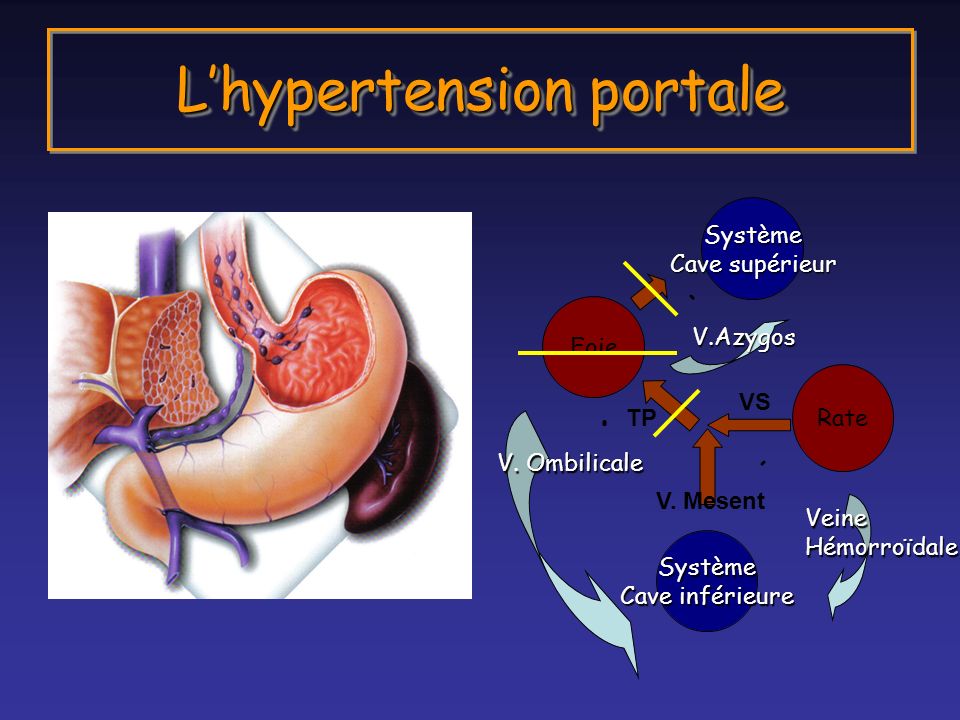 L’hypertension portale