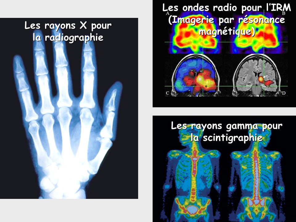 Les ondes radio pour l’IRM (Imagerie par résonance magnétique)