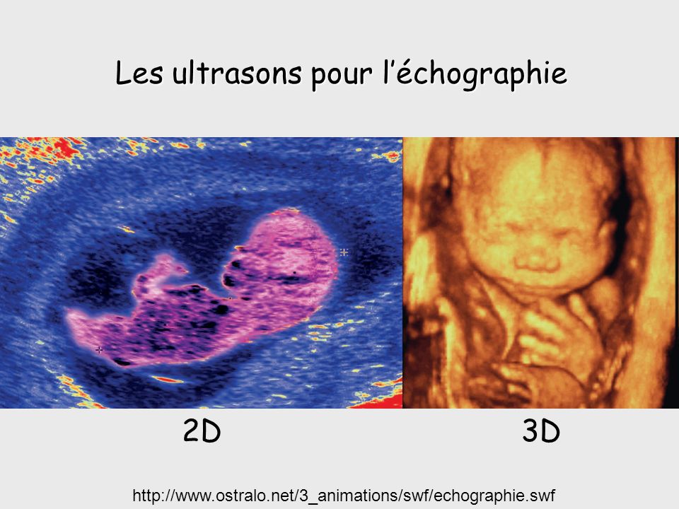 Les ultrasons pour l’échographie