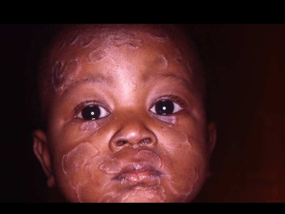 1986 Congenital syphilis. Esther, 6 months disseminated eruption all over her body