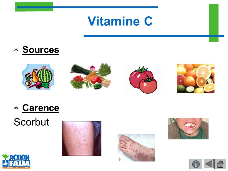 Vitamine C Scorbut Sources Carence