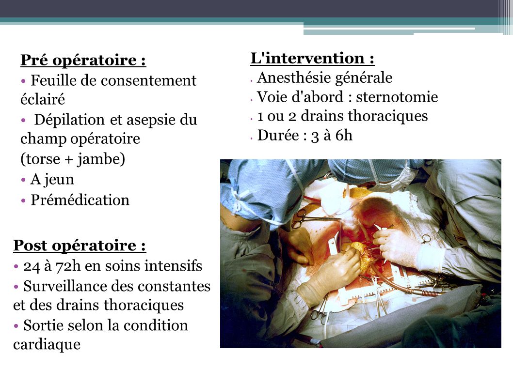 L intervention : Anesthésie générale. Voie d abord : sternotomie. 1 ou 2 drains thoraciques. Durée : 3 à 6h.