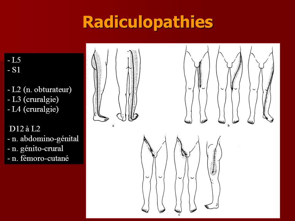 Radiculopathies - L5 - S1 - L2 (n. obturateur) L3 (cruralgie)