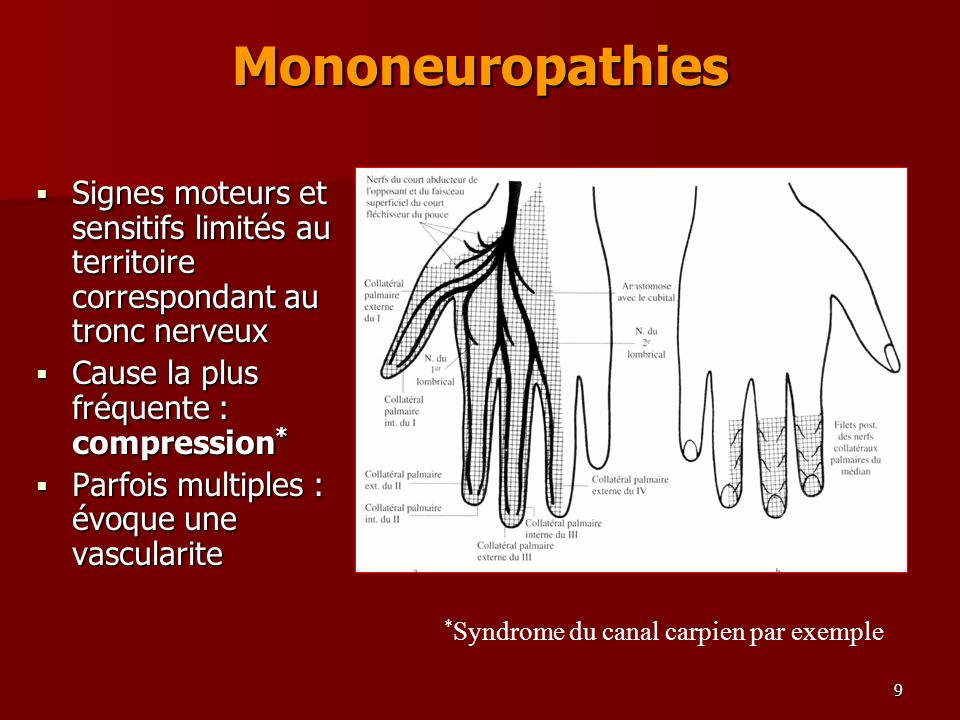 Mononeuropathies Signes moteurs et sensitifs limités au territoire correspondant au tronc nerveux. Cause la plus fréquente : compression*