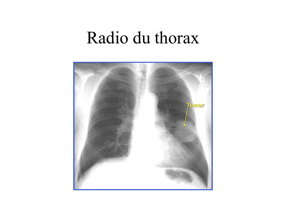 Radio du thorax