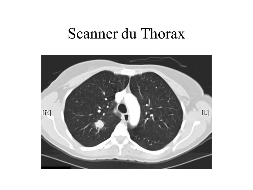 Scanner du Thorax